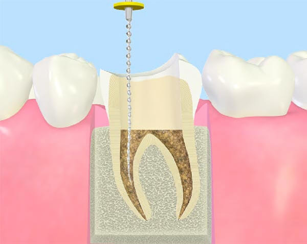 歯を残すための「歯内治療」