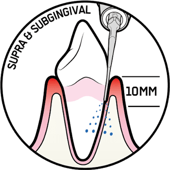 スマートピエゾンによる歯石除去2