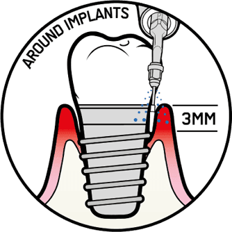 スマートピエゾンによる歯石除去3