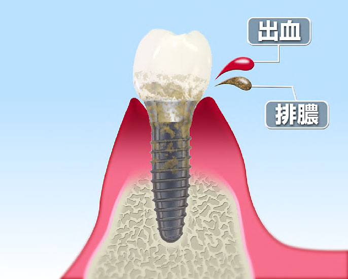 インプラントを永くご活用いただくために