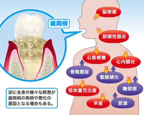 歯周病と全身疾患の関係